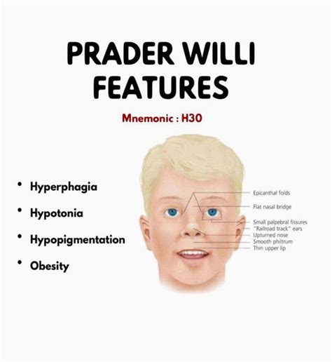 prada willi sundrome|prader willi syndrome pdf.